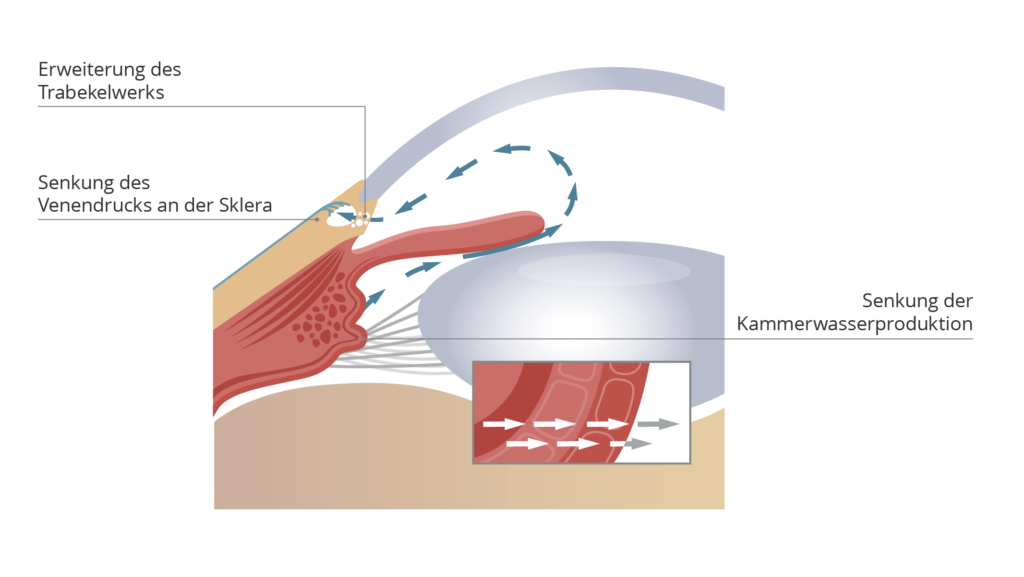 Grüner Star Behandlung Augenklinik Glaukom Therapie
